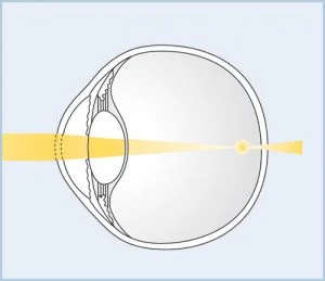 Examination & treatment of myopia at the German Eye Clinic Tirana: