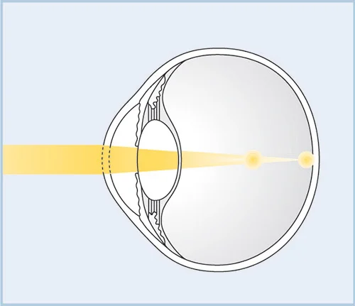 Examination & treatment of astigmatism at the German Eye Clinic Tirana: