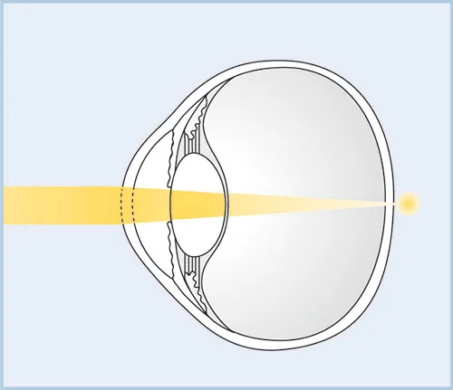 Examination & treatment of hyperopia at the German Eye Clinic Tirana:
